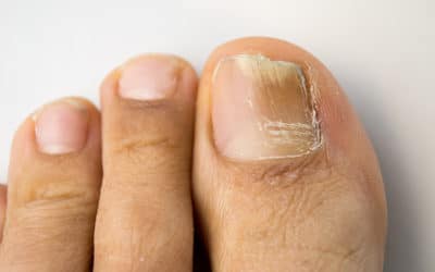 Clearing up Toenail Fungus with Laser Therapy
