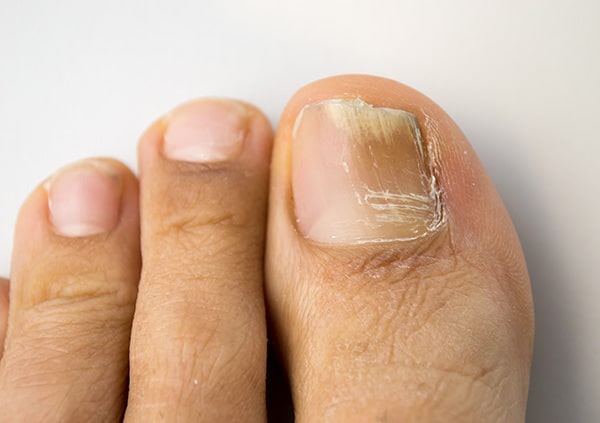 Clearing up Toenail Fungus with Laser Therapy