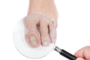 Toenail Fungus