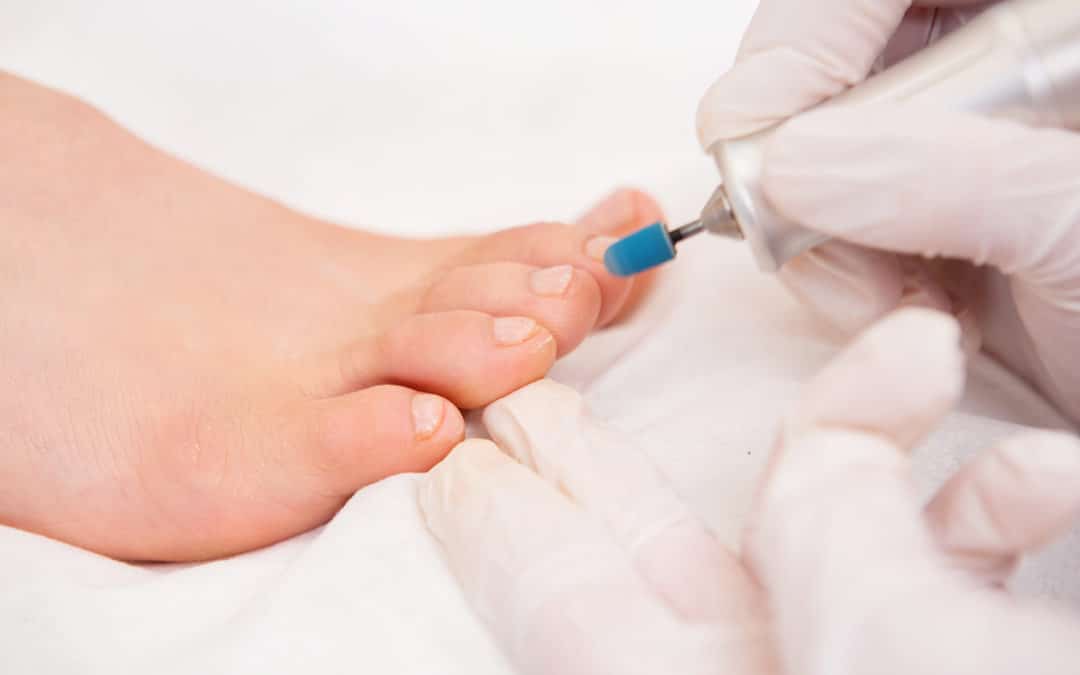 Women Should Watch for Fungal Nails, Too
