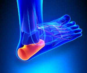 Chronic Heel Pain? How Laser Therapy Could Help