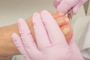 Options in treating ingrown toenails