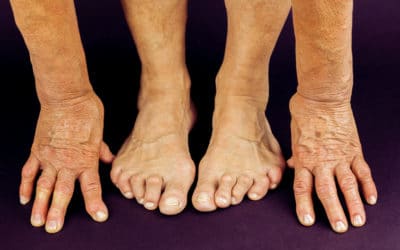 How Are Bunions and Arthritis Related?