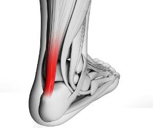 Who’s at Risk for Achilles Tendon Problems?