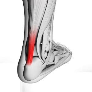 Who’s at Risk for Achilles Tendon Problems?