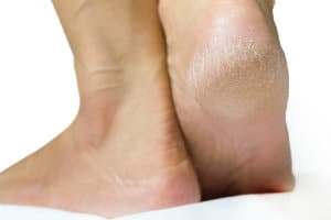 Tips for Reviving Dry Feet