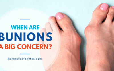 When Bunions are a Concern.