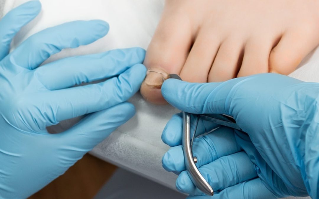 Ingrown Toenails: Causes, Symptoms, Treatment & Prevention