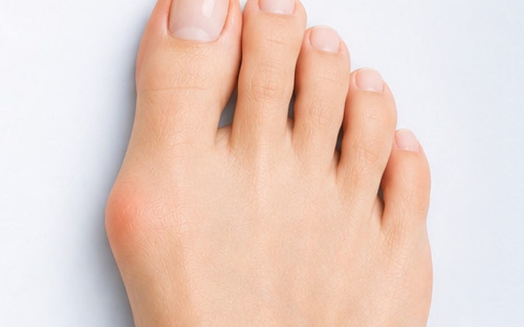 Lapiplasty®: A Modern Solution for Lasting Bunion Correction
