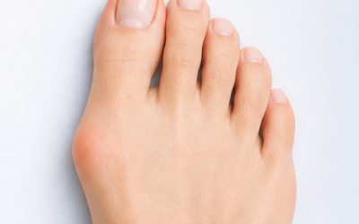 Lapiplasty®: A Modern Solution for Lasting Bunion Correction