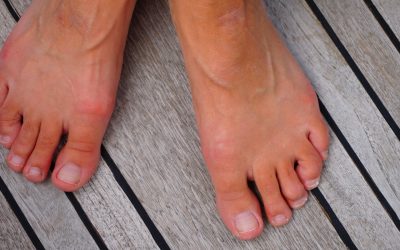 Don’t Let Hammertoes Get You Bent Out of Shape
